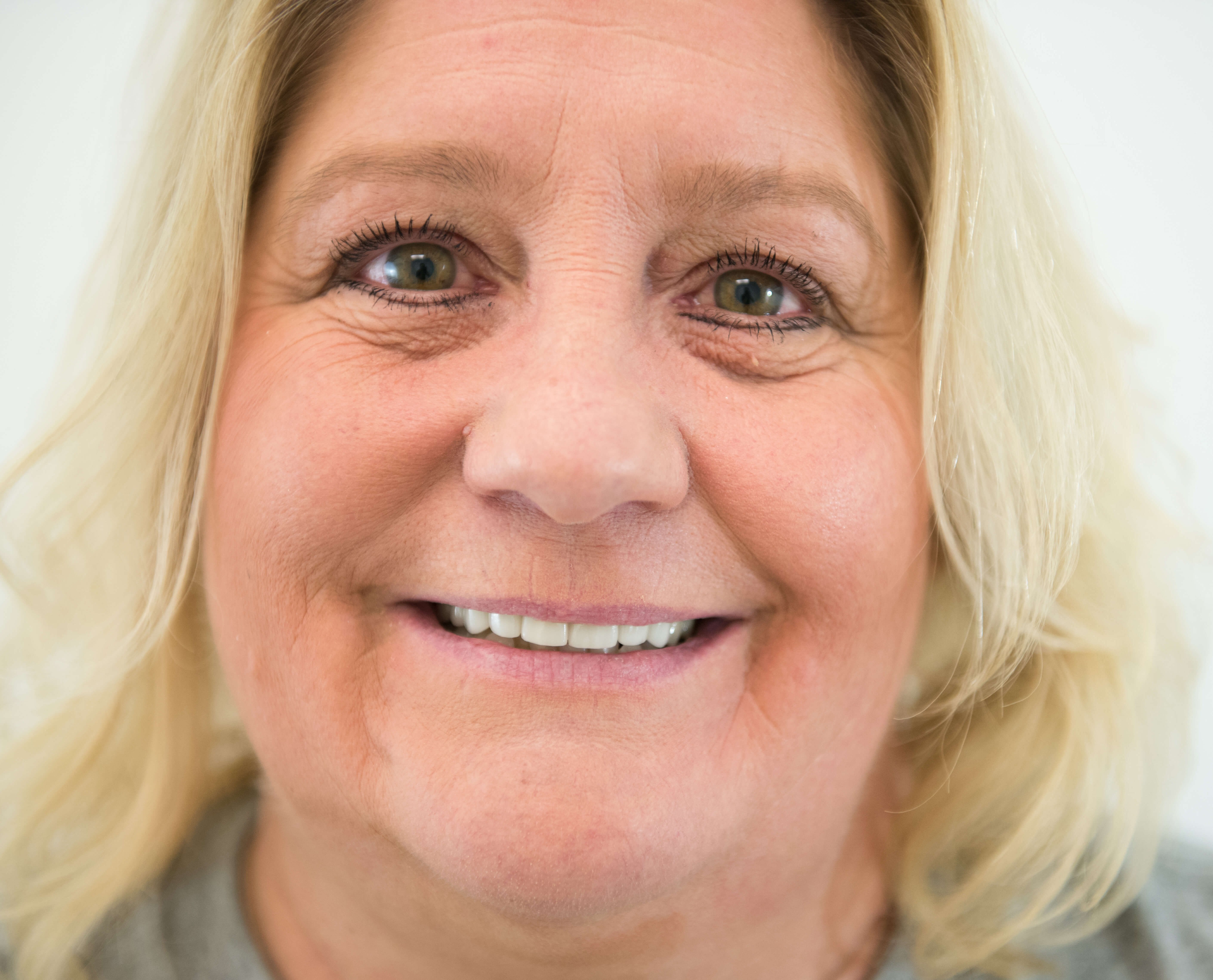 Anti Aging Dentistry After