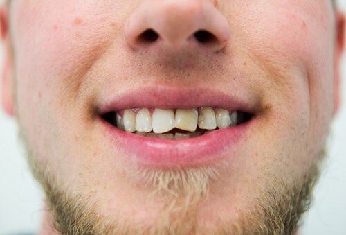 Smile makeover Before