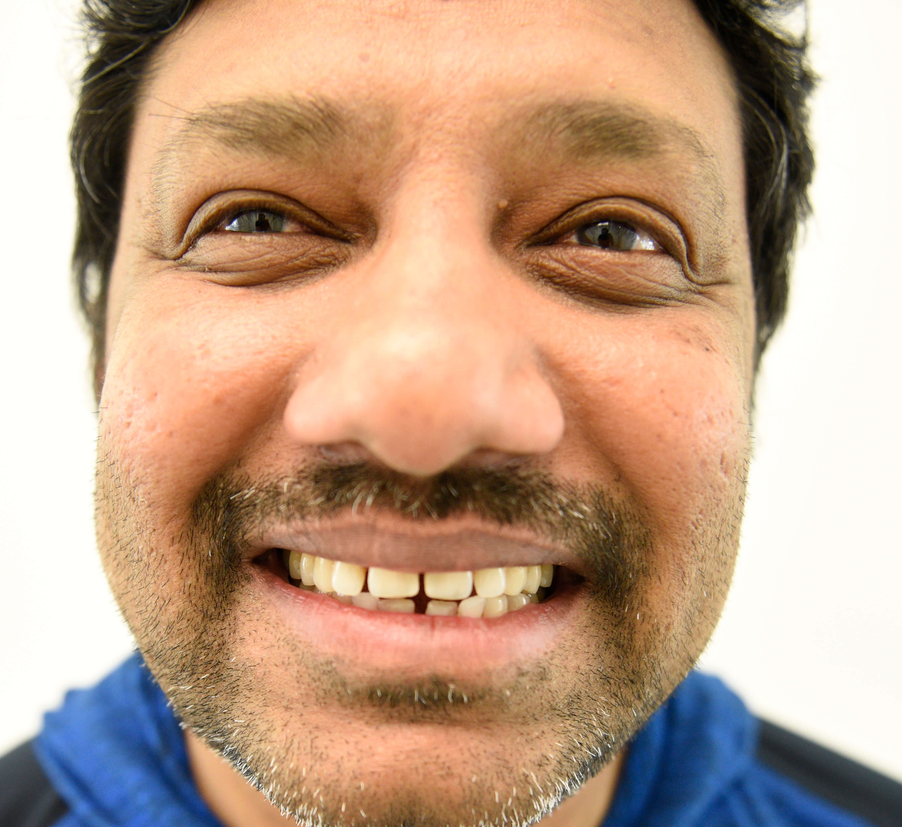 Smile Makeover Before