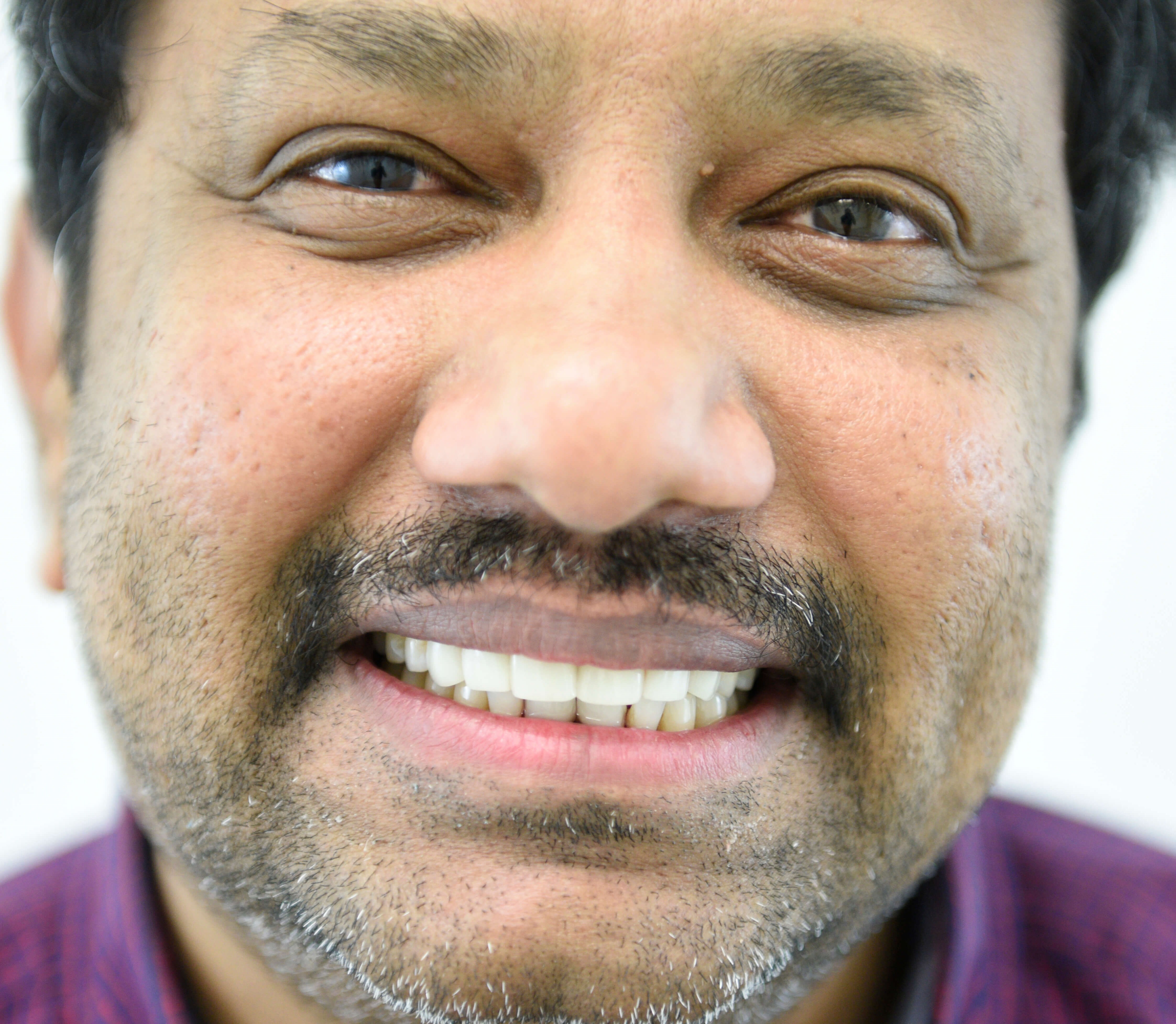 Smile Makeover After