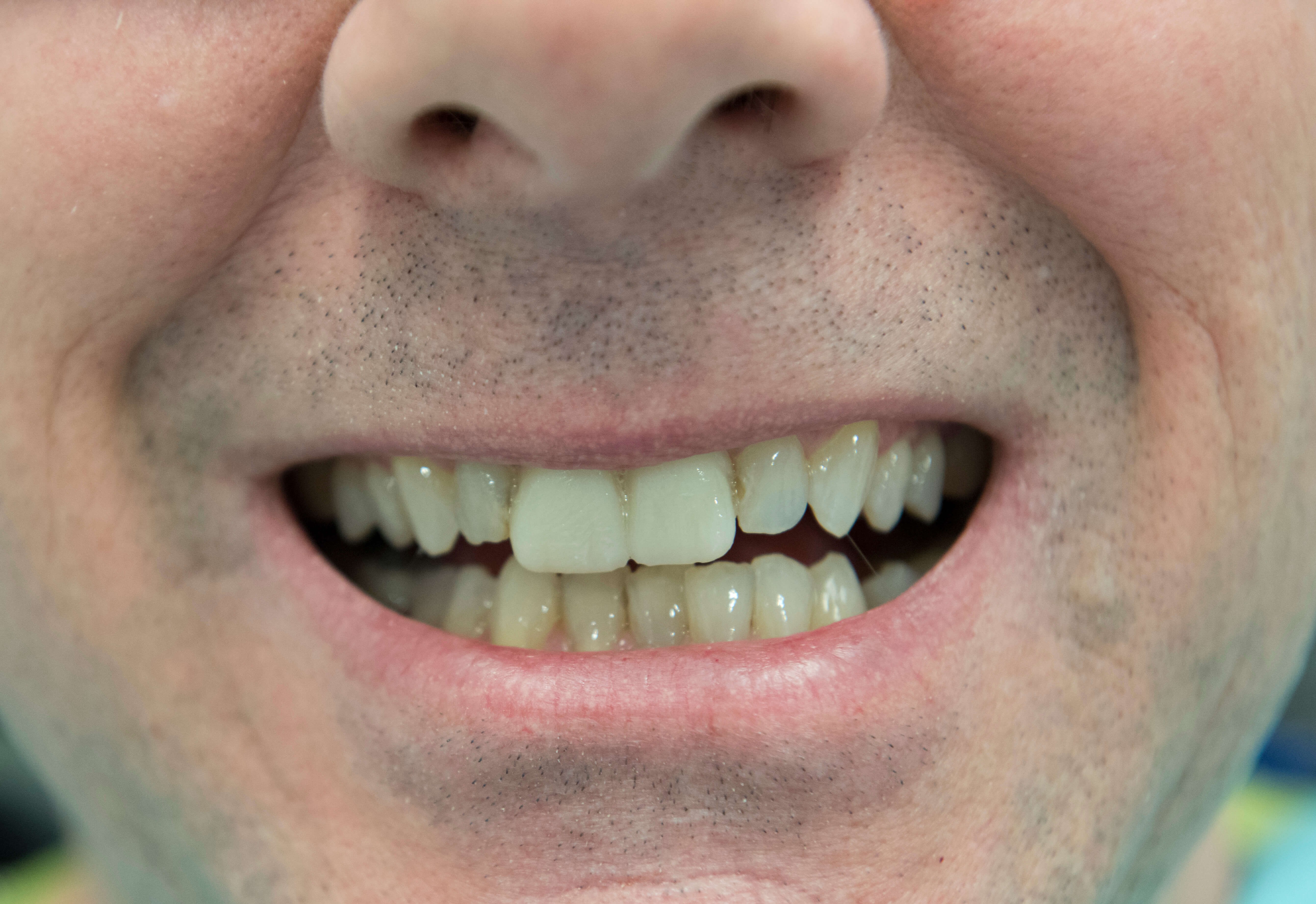 Porcelain Crowns Before