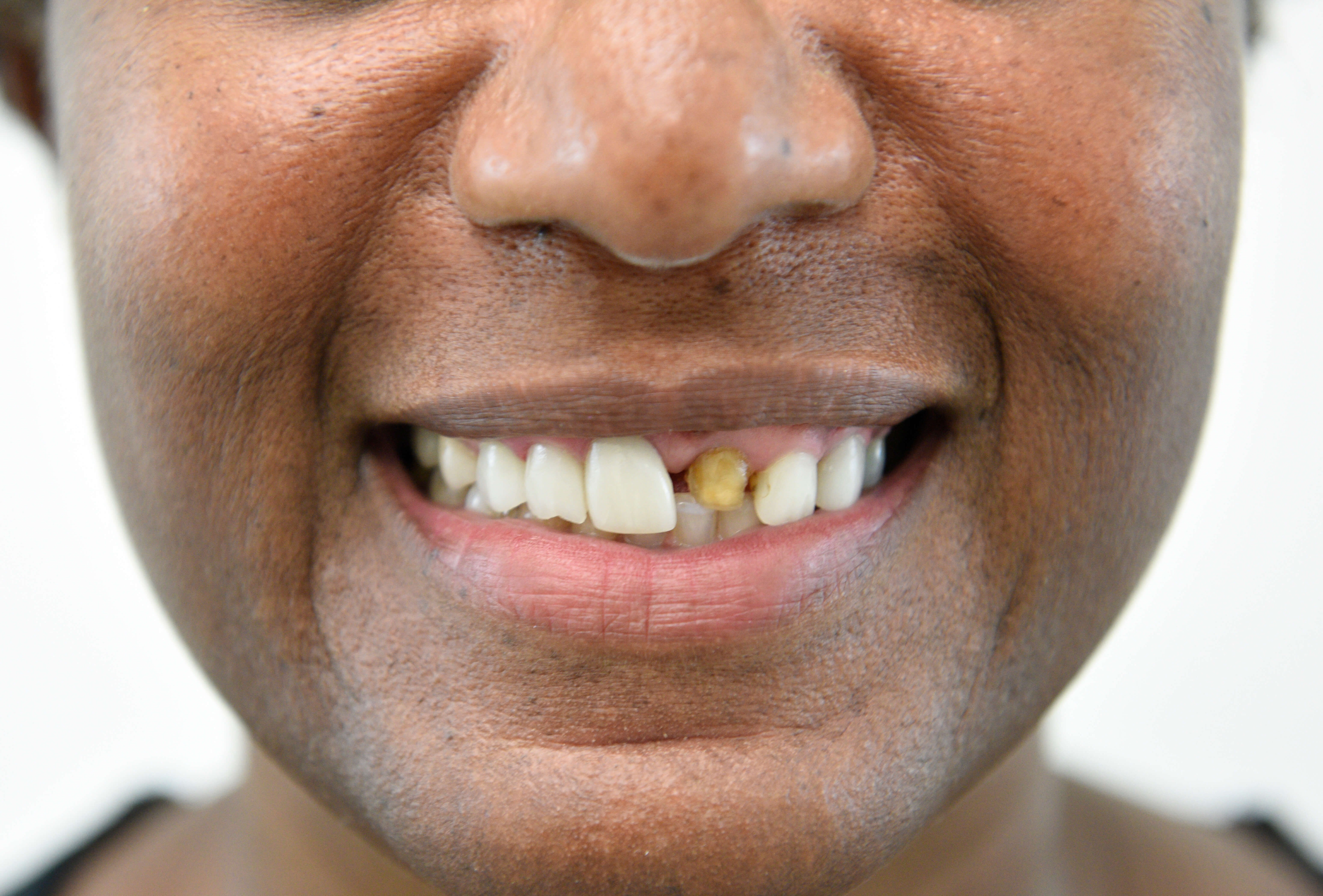 Smile Makeover Before