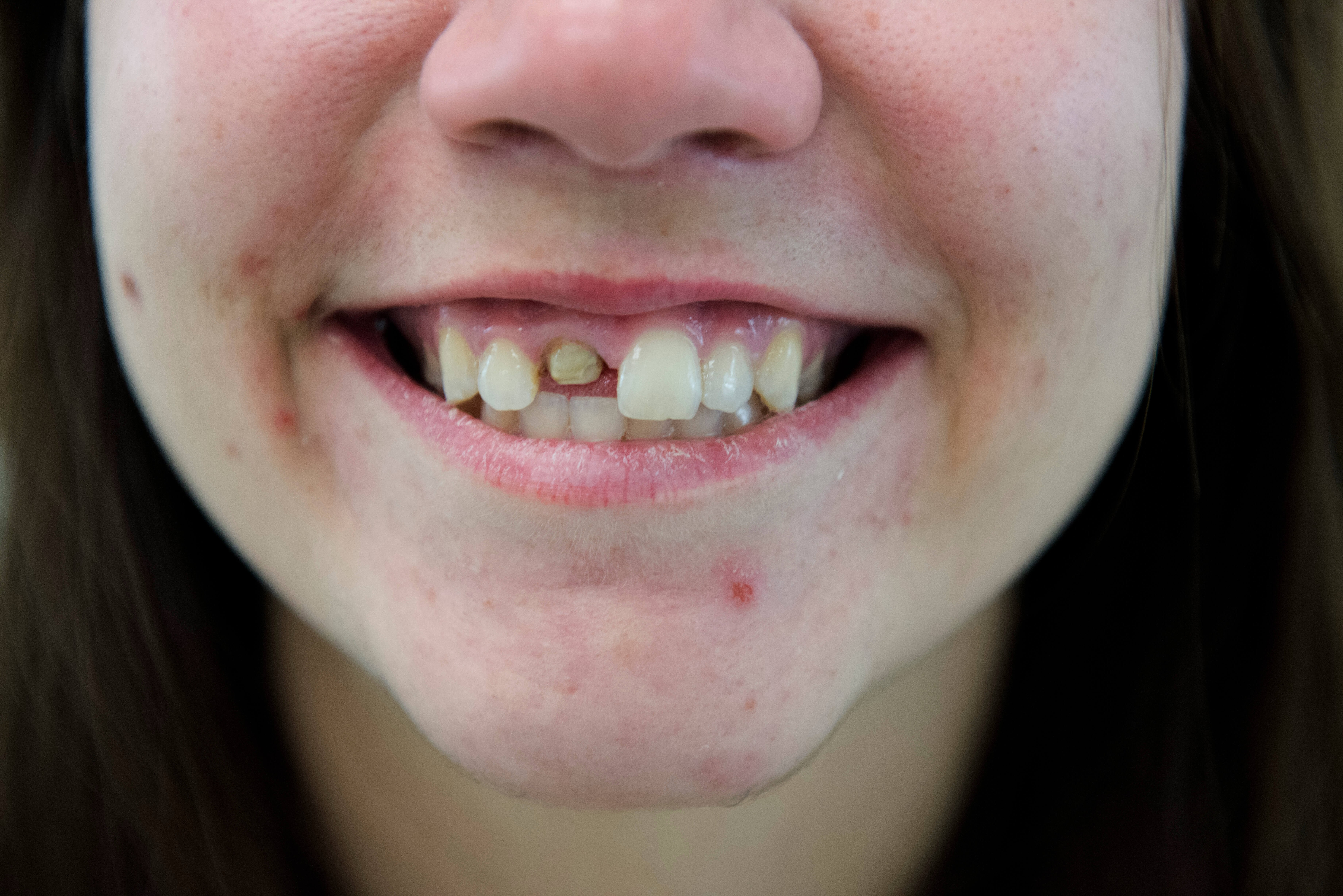 Full Mouth Rehabilitation Before