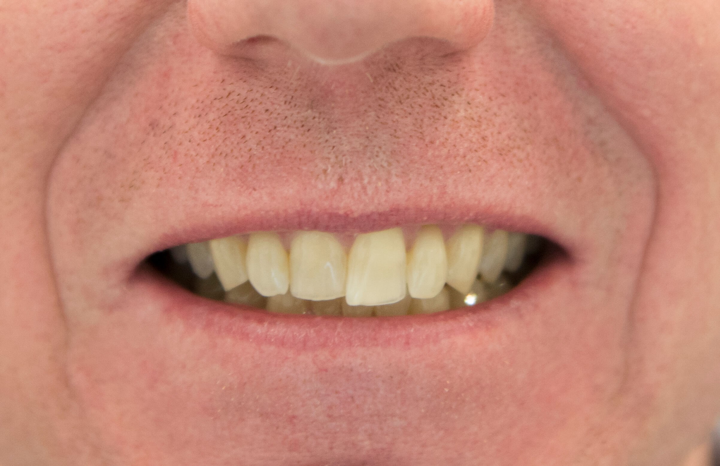 Smile Makeover Before