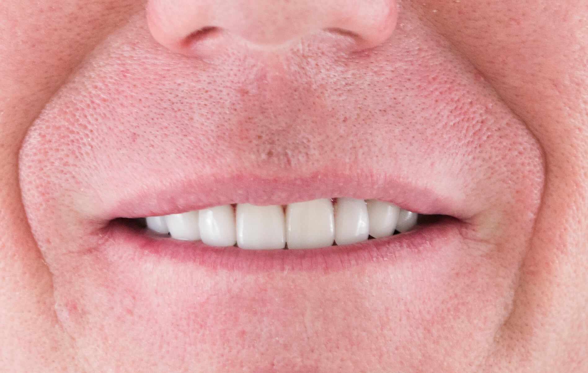 Smile Makeover After