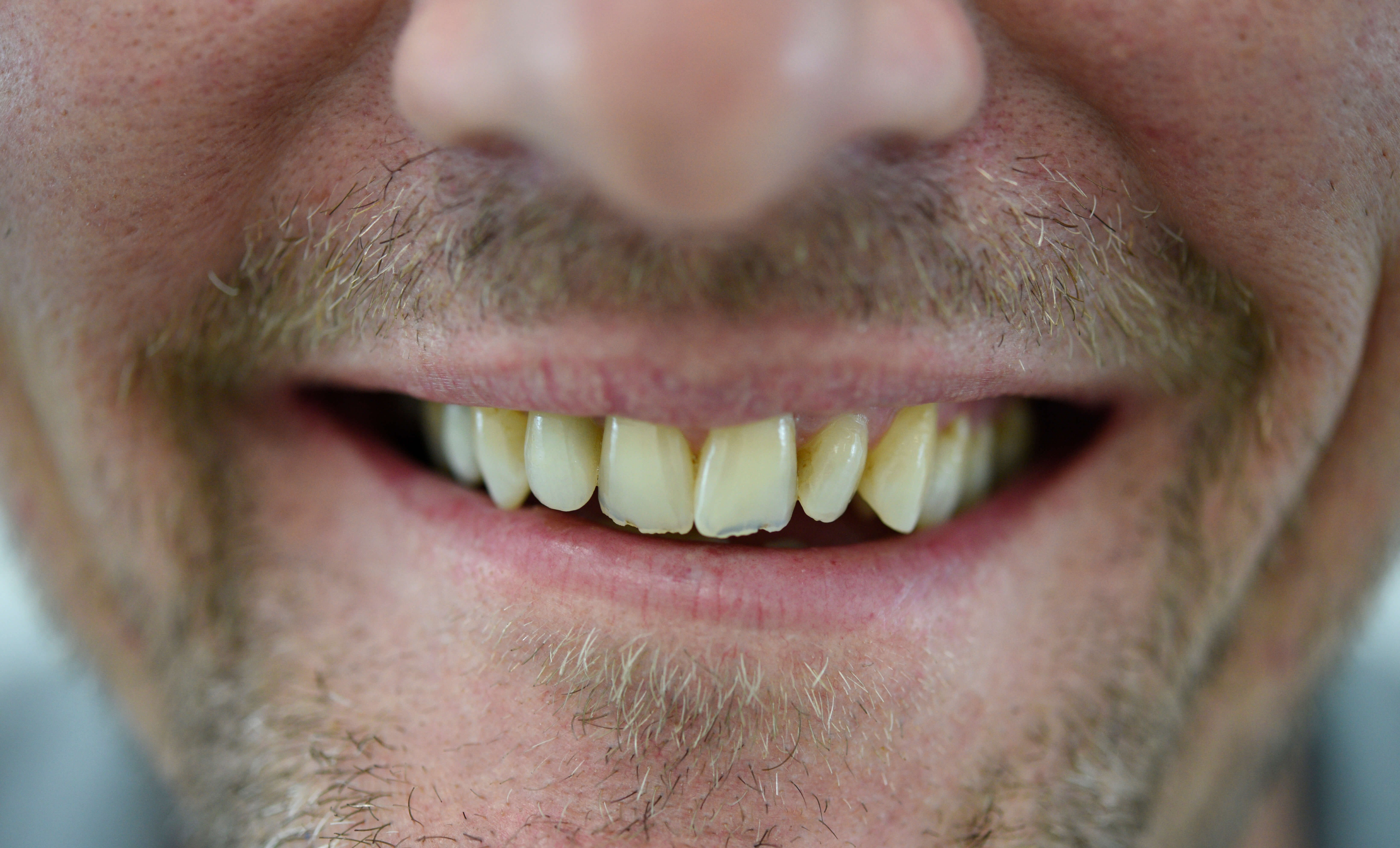 Full Mouth Makeover Before