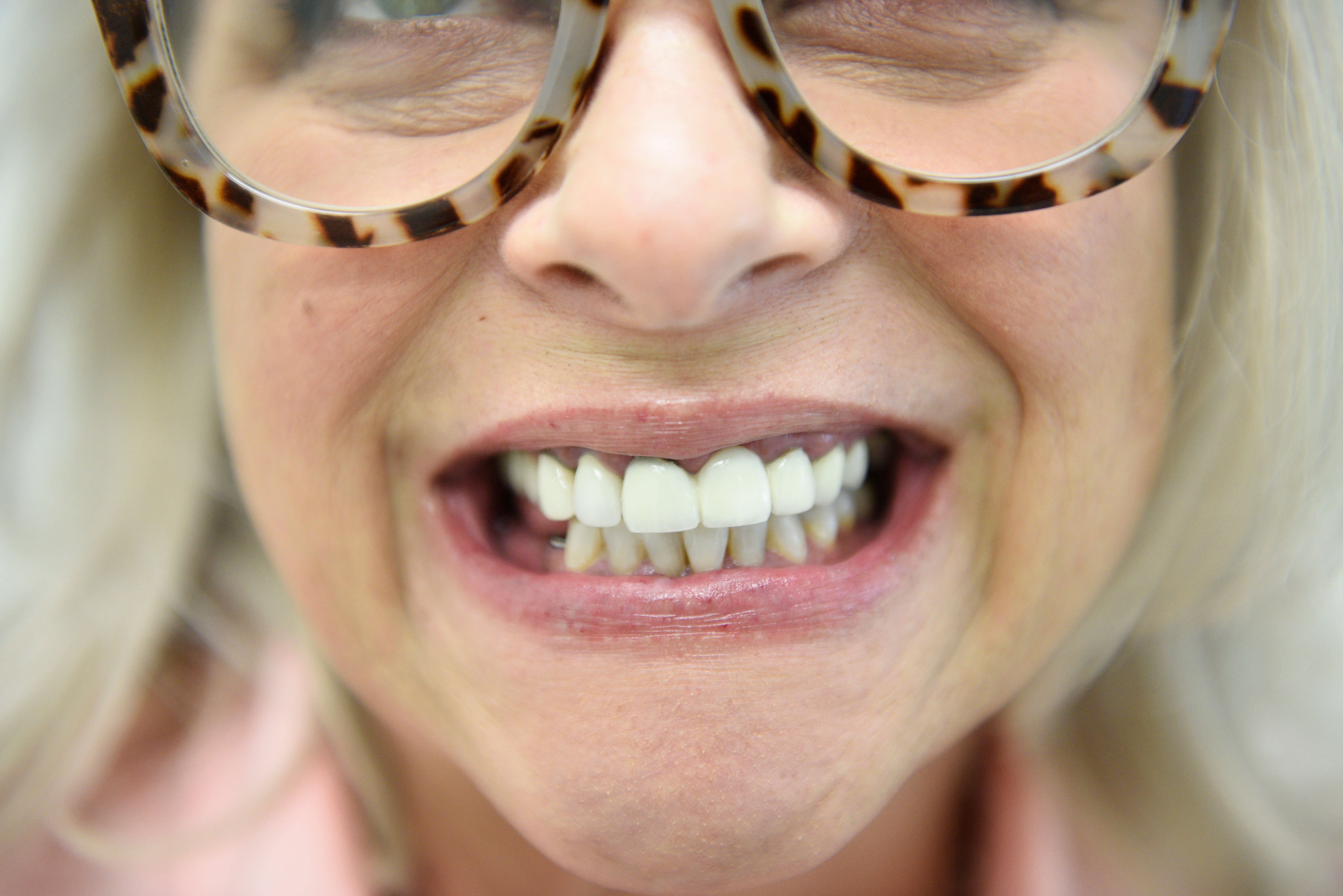 Porcelain Crowns Before