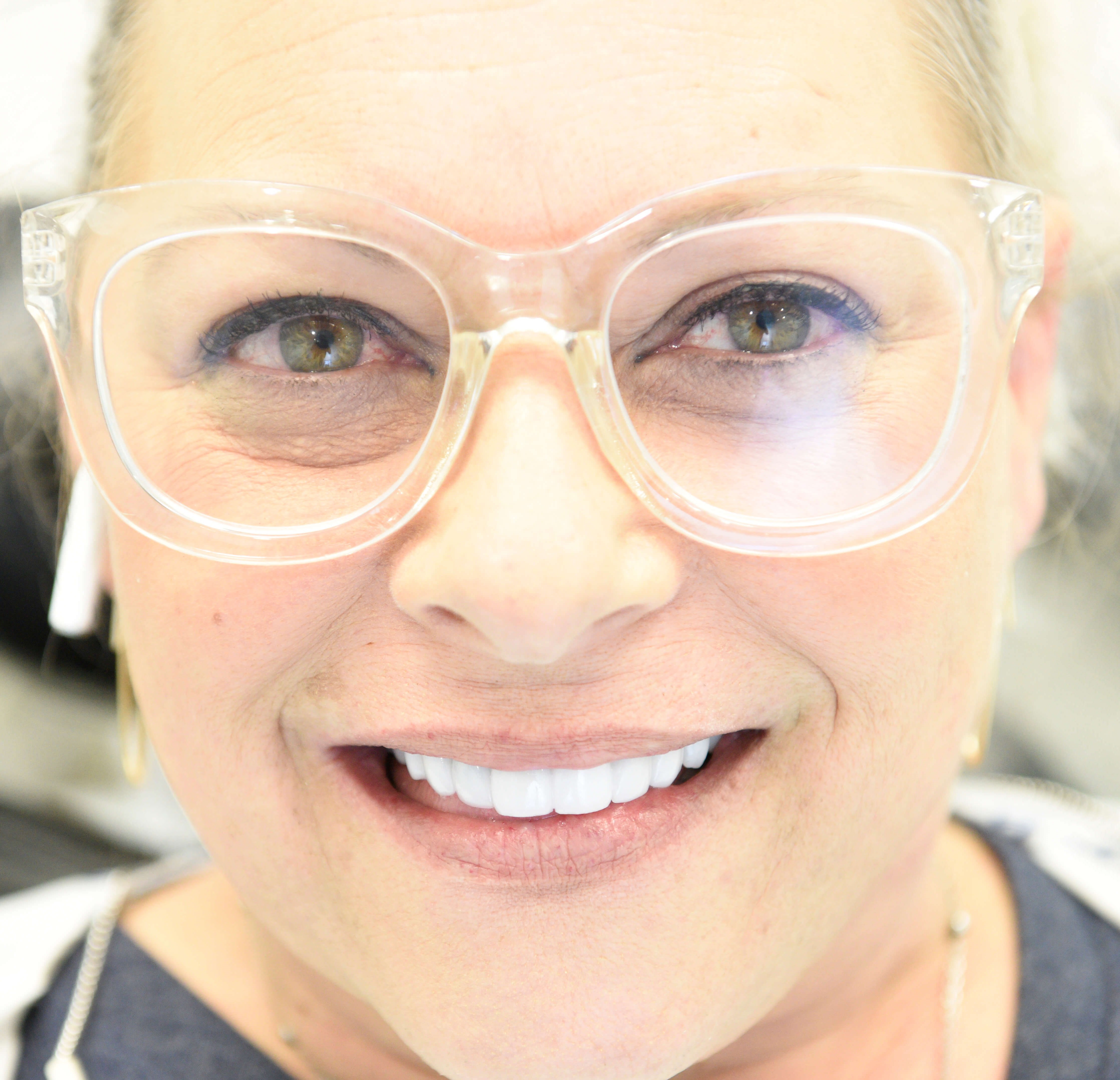 Porcelain Crowns After