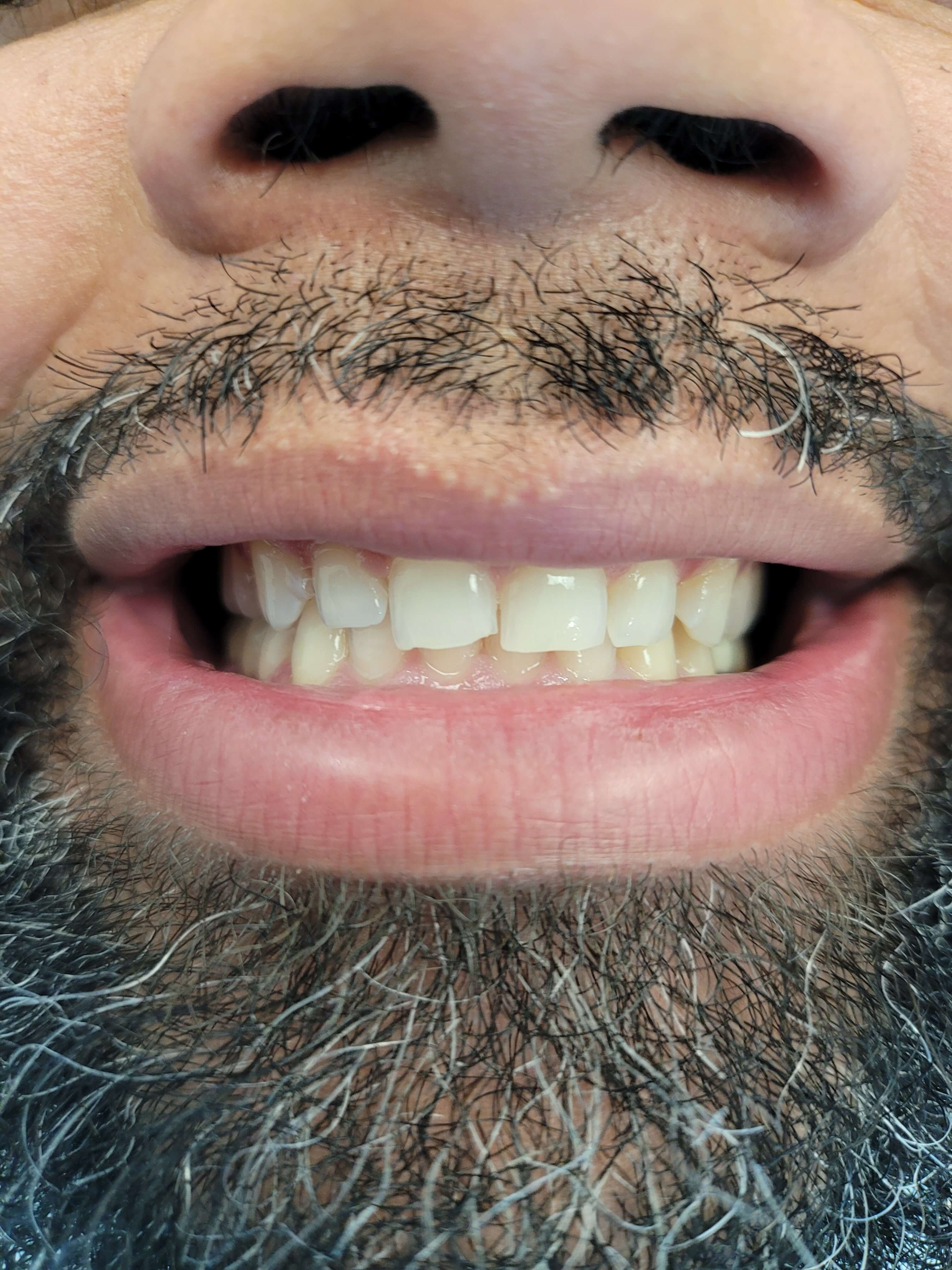 Full Esthetic Porcelain Veneer Before