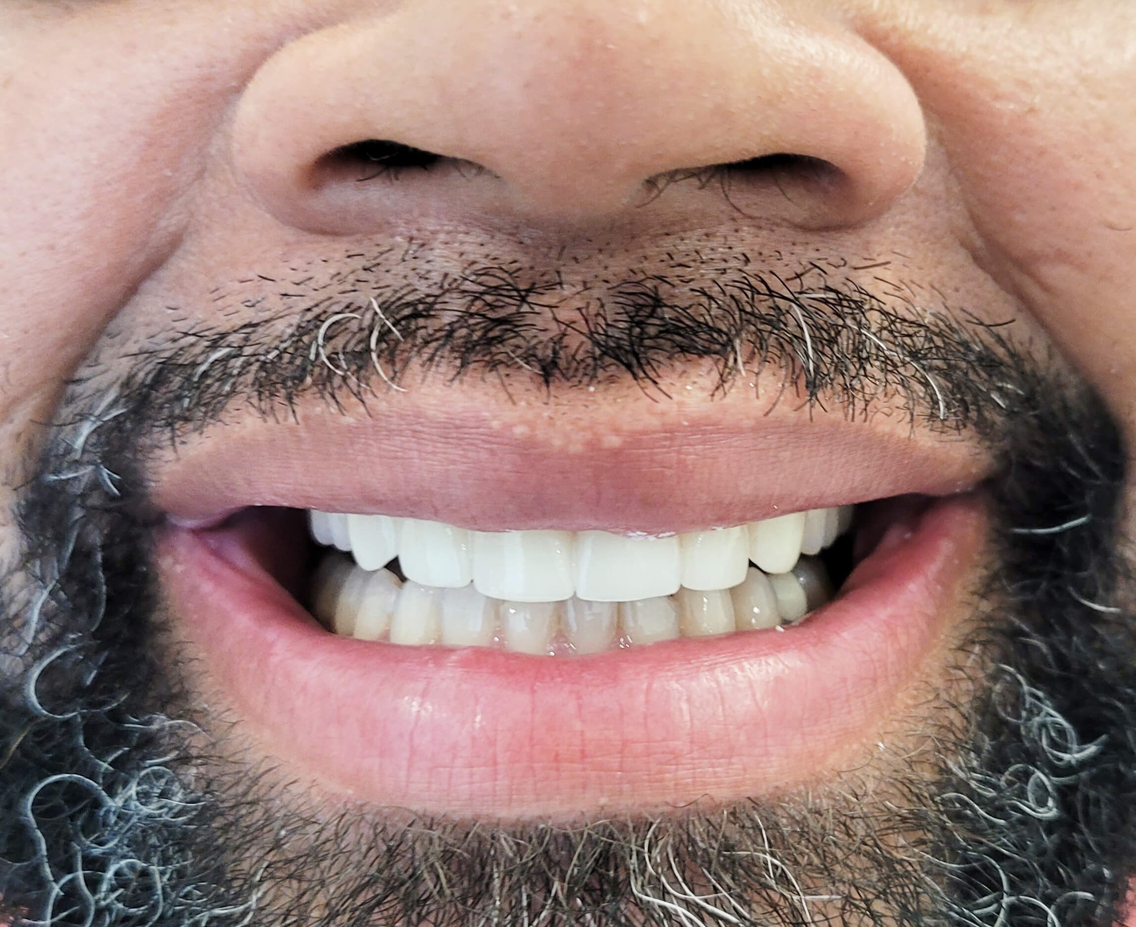 Full Esthetic Porcelain Veneer After