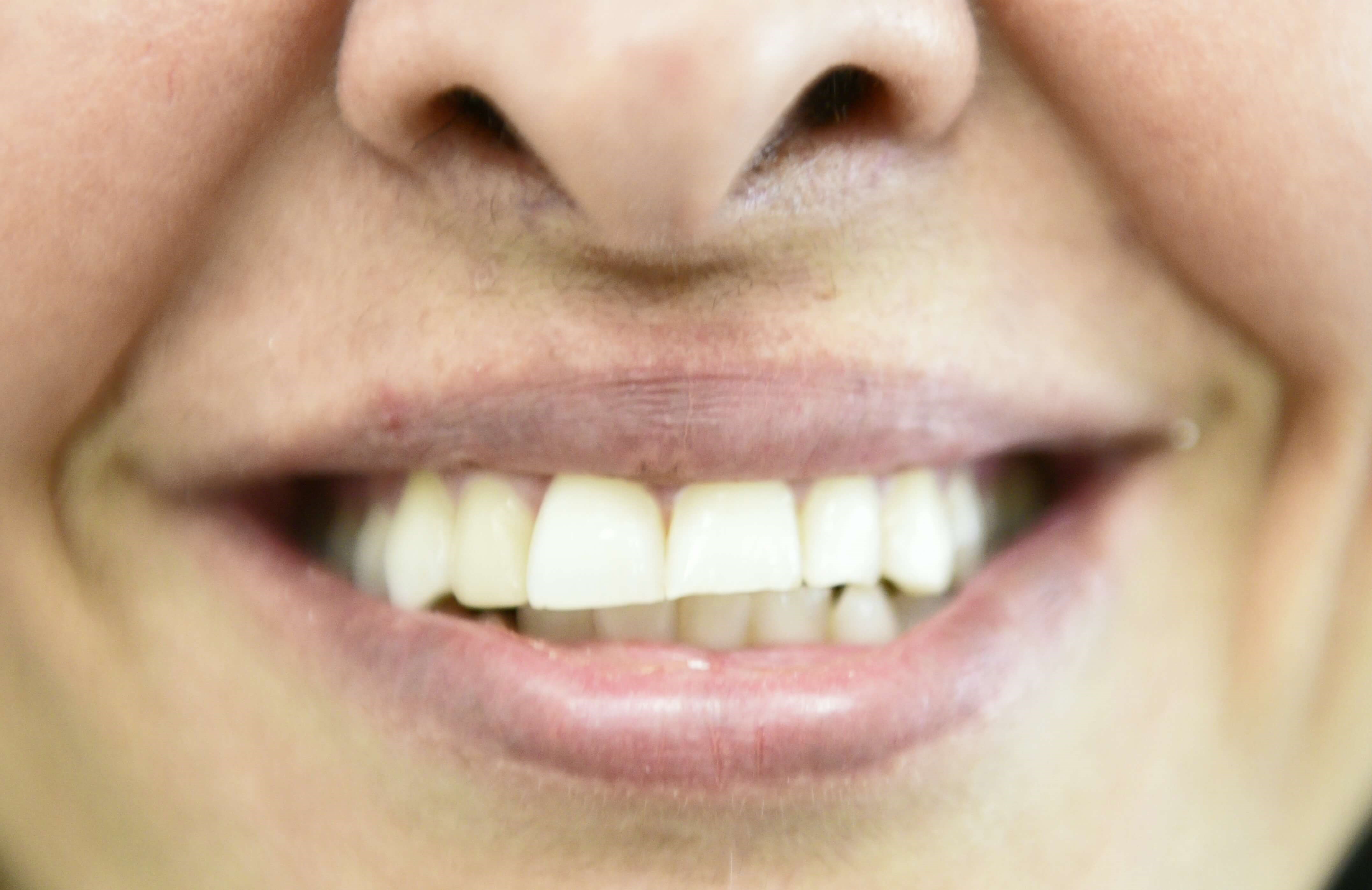 Porcelain Veneers Before