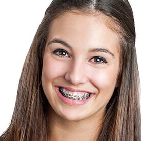 Conventional Braces