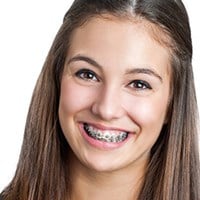 Conventional Braces